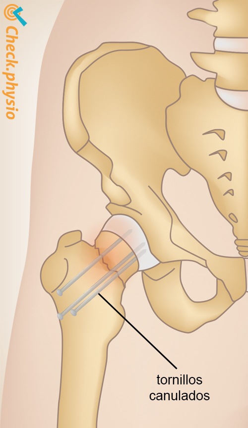 fractura de cadera fijación de tornillos
