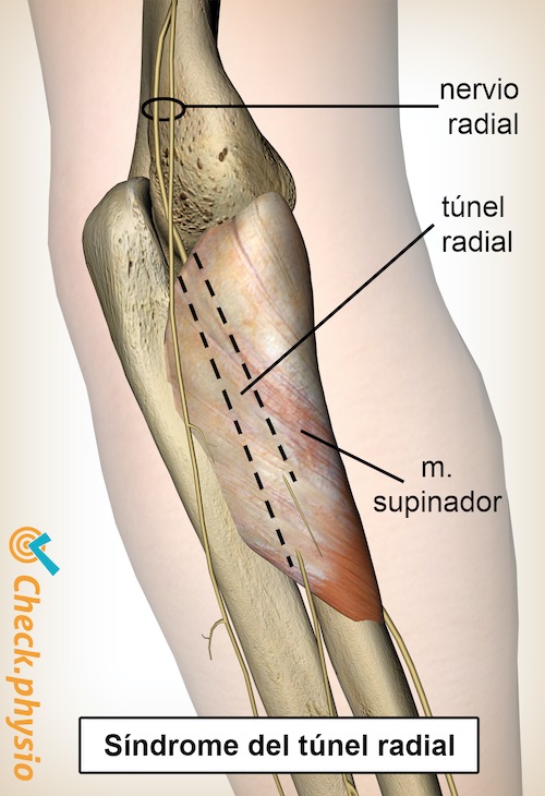 brazo túnel radial nervio radial