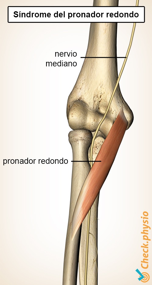 antebrazo músculo pronador redondo síndrome del nervio mediano