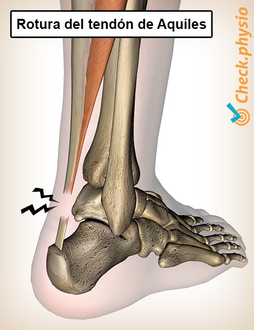 parte inferior de la pierna rotura del tendón de Aquiles