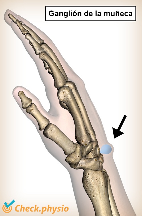 muñeca ganglión hinchazón anatomía quiste mucoide