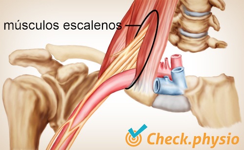 hombro brazo mano síndrome de salida torácica triángulo escaleno