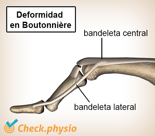 dedo deformidad en boutonniere tendón extensor bandeleta central lateral