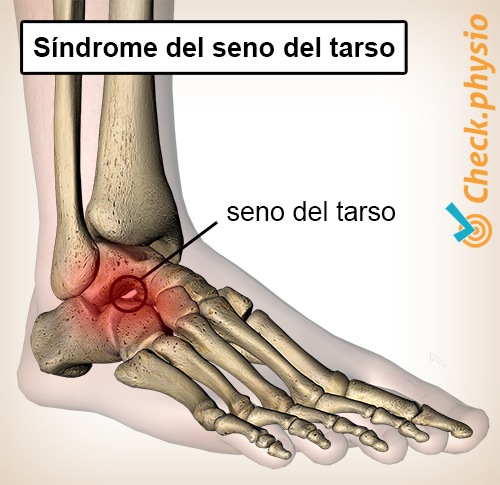pie síndrome del seno tarsiano túnel