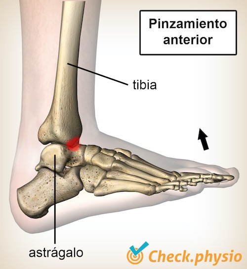 tobillo pinzamiento anterior flexión dorsal