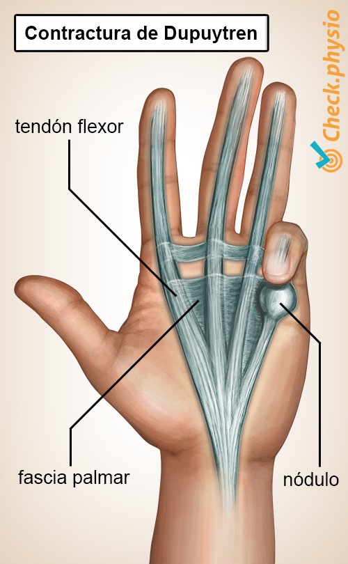 mano enfermedad de Dupuytren nódulo palmar