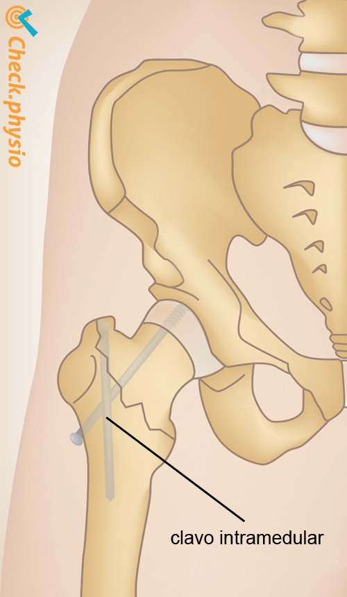 fractura de cadera clavo gamma