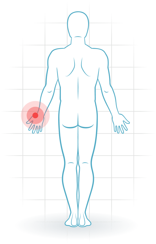 pijnlocatie Artritis de la base del pulgar o rizartrosis