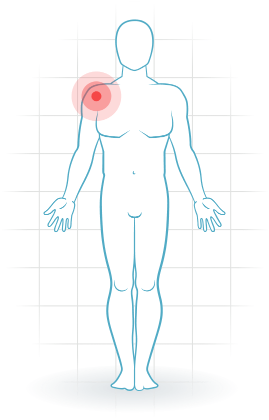 pijnlocatie Artrosis del hombro